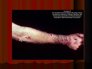 Micoses superficiais