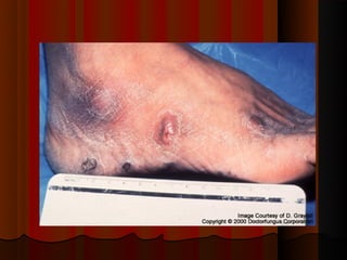 Micoses superficiais