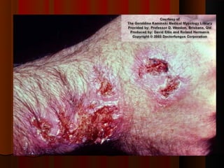 Micoses superficiais