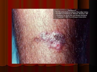 Micoses superficiais