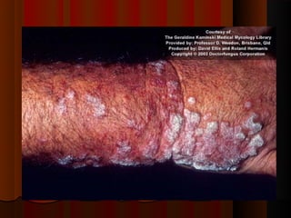 Micoses superficiais