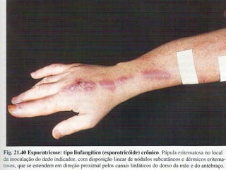 Micoses superficiais