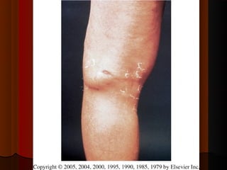 Micoses superficiais