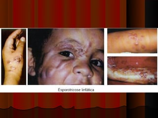 Micoses superficiais