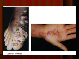 Micoses superficiais