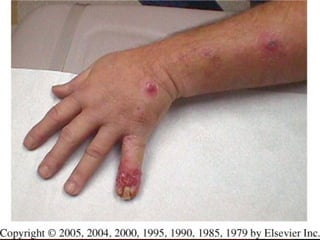 Micoses superficiais