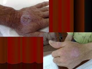 Micoses superficiais