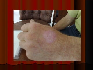 Micoses superficiais