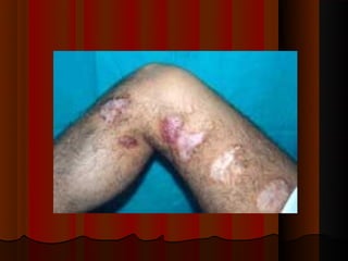 Micoses superficiais