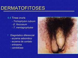 DERMATOFITOSES
  4.4 Tinea cruris
       - Trichophyton rubrum
       - E. floccosum
       - T. mentagrophytes


     Diagnóstico diferencial
      - eczema seborréico
      - eczema de contato
      - eritrasma
      - candidíase
 