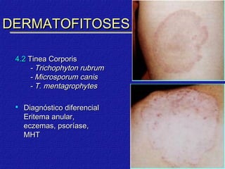DERMATOFITOSES

 4.2 Tinea Corporis
     - Trichophyton rubrum
     - Microsporum canis
     - T. mentagrophytes

    Diagnóstico diferencial
     Eritema anular,
     eczemas, psoríase,
     MHT
 