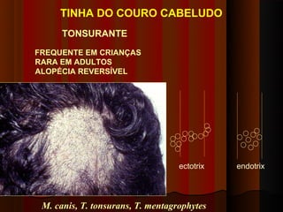 TINHA DO COURO CABELUDO
      TONSURANTE
FREQUENTE EM CRIANÇAS
RARA EM ADULTOS
ALOPÉCIA REVERSÍVEL




                                   ectotrix   endotrix




 M. canis, T. tonsurans, T. mentagrophytes
 