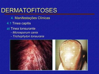 DERMATOFITOSES
    4. Manifestações Clínicas
 4.1 Tinea capitis
 a) Tinea tonsurante
   - Microsporum canis
   - Trichophyton tonsurans
 