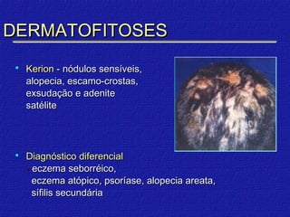 DERMATOFITOSES
    Kerion - nódulos sensíveis,
     alopecia, escamo-crostas,
     exsudação e adenite
     satélite




    Diagnóstico diferencial
     - eczema seborréico,
       eczema atópico, psoríase, alopecia areata,
       sífilis secundária
 