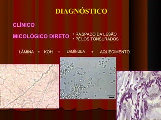 DIAGNÓSTICO
CLÍNICO
                        • RASPADO DA LESÃO
MICOLÓGICO DIRETO       • PÊLOS TONSURADOS


 LÂMINA   + KOH   +   LAMÍNULA   +   AQUECIMENTO
 