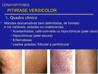 CERATOFITOSES
       PITIRÍASE VERSICOLOR
     5. Quadro clínico
    Máculas descamativas bem delimitadas, de formato
     e cor variáveis, isoladas ou coalescentes
          Acastanhadas, café-com-leite ou hipocrômicas (pele clara)
          Hipocrômicas (pele escura)
          Eritematosas
          Lesões gotadas: folicular e perifolicular
 
