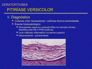 CERATOFITOSES
  PITIRÍASE VERSICOLOR
  9. Diagnóstico
      Culturas (não necessárias): colônias branco-amareladas
      Exame histopatológico
          Abundantes esporos e pseudo-hifas na camada córnea,
           basófilas pela HE e PAS positivas
          Leve infiltrado inflamatório na derme superior
          Hiperceratose - paraceratose
 