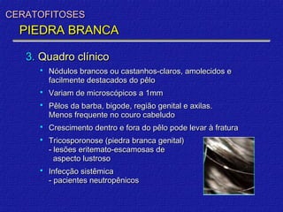 CERATOFITOSES
  PIEDRA BRANCA

   3. Quadro clínico
        Nódulos brancos ou castanhos-claros, amolecidos e
         facilmente destacados do pêlo
        Variam de microscópicos a 1mm
        Pêlos da barba, bigode, região genital e axilas.
         Menos frequente no couro cabeludo
        Crescimento dentro e fora do pêlo pode levar à fratura
        Tricosporonose (piedra branca genital)
         - lesões eritemato-escamosas de
           aspecto lustroso
        Infecção sistêmica
         - pacientes neutropênicos
 