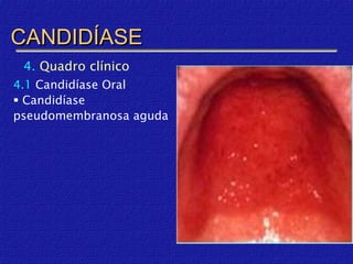 CANDIDÍASE
 4. Quadro clínico
4.1 Candidíase Oral
 Candidíase
pseudomembranosa aguda
 