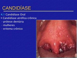 CANDIDÍASE
4.1 Candidíase Oral
 Candidíase atrófica crônica
 - prótese dentária
 - mulheres
 - eritema crônico
 