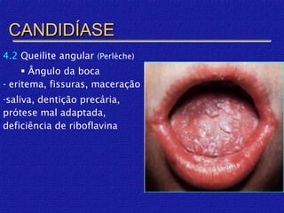 CANDIDÍASE
4.2 Queilite angular (Perlèche)
      Ângulo da boca
- eritema, fissuras, maceração
-saliva, dentição precária,
prótese mal adaptada,
deficiência de riboflavina
 