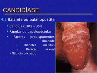 CANDIDÍASE
4.5 Balanite ou balanopostite
    Cândidas: 30% – 35%
    Pápulas ou papulopústulas
        Fatores     predisponentes
                  -           Umidade
           -     Diabetes      mellitus
             -      Relação     sexual
       - Não circuncisado
 