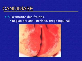 CANDIDÍASE
4.8 Dermatite das fraldas
    Região perianal, períneo, prega inguinal
 