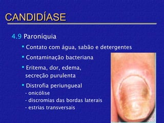 CANDIDÍASE
 4.9 Paroníquia
     Contato com água, sabão e detergentes
     Contaminação bacteriana
     Eritema, dor, edema,
      secreção purulenta
     Distrofia periungueal
     - onicólise
     - discromias das bordas laterais
     - estrias transversais
 