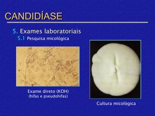 CANDIDÍASE
 5. Exames laboratoriais
  5.1 Pesquisa micológica




      Exame direto (KOH)
       (hifas e pseudohifas)
                               Cultura micológica
 