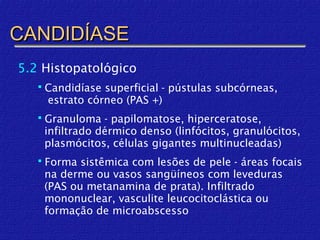 CANDIDÍASE
5.2 Histopatológico
    Candidíase superficial - pústulas subcórneas,
    estrato córneo (PAS +)
    Granuloma - papilomatose, hiperceratose,
    infiltrado dérmico denso (linfócitos, granulócitos,
    plasmócitos, células gigantes multinucleadas)
    Forma sistêmica com lesões de pele - áreas focais
    na derme ou vasos sangüíneos com leveduras
    (PAS ou metanamina de prata). Infiltrado
    mononuclear, vasculite leucocitoclástica ou
    formação de microabscesso
 