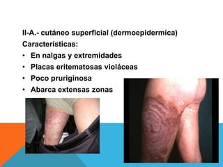 II-A.- cutáneo superficial (dermoepidermica)
Características:
• En nalgas y extremidades
• Placas eritematosas violáceas
• Poco pruriginosa
• Abarca extensas zonas
 