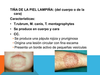 TIÑA DE LA PIEL LAMPIÑA: (del cuerpo o de la
  cara)
Características:
• T.rubrum, M. canis, T. mentagrophytes
• Se produce en cuerpo y cara
• CC.
  • Se produce una pápula rojiza y pruriginosa
  • Origina una lesión circular con fina escama
  • Presenta un borde activo de pequeñas vesículas
 