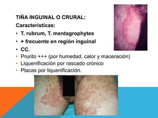 TIÑA INGUINAL O CRURAL:
Características:
• T. rubrum, T. mentagrophytes
• + frecuente en región inguinal
•   CC.
•   Prurito +++ (por humedad, calor y maceración)
•   Liquenificación por rascado crónico
•   Placas por liquenificación.
 