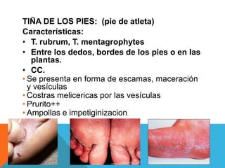 TIÑA DE LOS PIES: (pie de atleta)
Características:
• T. rubrum, T. mentagrophytes
• Entre los dedos, bordes de los pies o en las
   plantas.
• CC.
• Se presenta en forma de escamas, maceración
  y vesículas
• Costras melicericas por las vesículas
• Prurito++
• Ampollas e impetiginizacion.
 