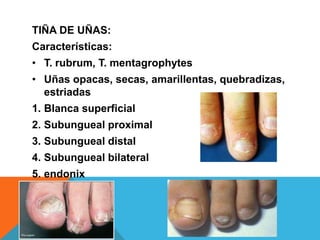 TIÑA DE UÑAS:
Características:
• T. rubrum, T. mentagrophytes
• Uñas opacas, secas, amarillentas, quebradizas,
  estriadas
1. Blanca superficial
2. Subungueal proximal
3. Subungueal distal
4. Subungueal bilateral
5. endonix
 