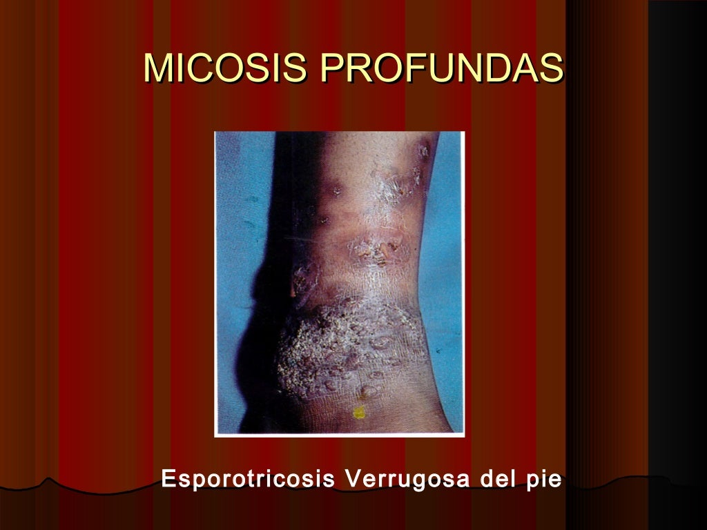 Micosis