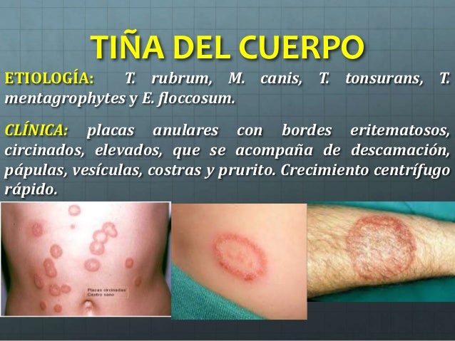 (2017-03-09)Micosis superficiales (PPT)