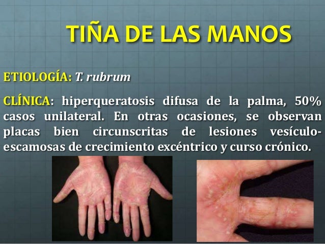 La eccema húmeda de la foto
