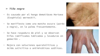 ➢ Tiña negra
- Es causada por el hongo dematiáceo Hortaea
(Exophiala) werneckii.
- Se manifiesta como una mancha oscura (parda
o negra), en la palma frecuentemente.
- Se hace raspadura de piel y se observan
hifas ramificadas tabicadas y levaduras en
gemación .
- Mejora con soluciones queratolíticas y
ácido salicílico o antimicóticos azólicos.
 