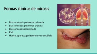 Formas clínicas de micosis
● Blastomicosis pulmonar primaria
● Blastomicosis pulmonar crónica
● Blastomicosis diseminada
● Piel
● Hueso, aparato genitourinario y encéfalo
 