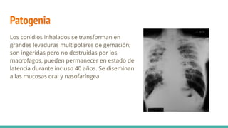 Patogenia
Los conidios inhalados se transforman en
grandes levaduras multipolares de gemación;
son ingeridas pero no destruidas por los
macrofagos, pueden permanecer en estado de
latencia durante incluso 40 años. Se diseminan
a las mucosas oral y nasofaríngea.
 