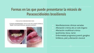 Formas en las que puede presentarse la micosis de
Paracoccidioides brasiliensis
● Manifestaciones clínicas variadas
● Afectación crónica de un solo órgano
● Afectación multifocal crónica
(pulmones, boca, nariz)
● Enfermedad progresiva juvenil: ganglios
linfáticos, piel y afectación visceral
 