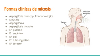 Formas clínicas de micosis
● Aspergilosis broncopulmonar alérgica
● Sinusitis
● Aspergiloma
● Aspergilosis invasiva
● En pulmón
● En encéfalo
● En piel
● En tubo digestivo
● En corazón
 