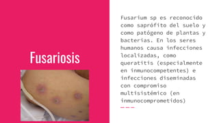 Fusariosis
Fusarium sp es reconocido
como saprófito del suelo y
como patógeno de plantas y
bacterias. En los seres
humanos causa infecciones
localizadas, como
queratitis (especialmente
en inmunocompetentes) e
infecciones diseminadas
con compromiso
multisistémico (en
inmunocomprometidos)
 