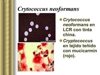 Crytococcus neoformans Crytococcus neoformans  en LCR con tinta china. Cryptococcus  en tejido teñido con mucicarmín (rojo). 