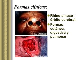 Formas clínicas : Rhino-sinuso-órbito-cerebral. Formas cutánea, digestiva y pulmonar 