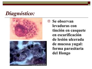Diagnóstico: Se observan levaduras con tinción en casquete en escarificación de lesión ulcerada de mucosa yugal: forma parasitaria del Hongo 