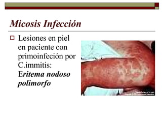Micosis Infección Lesiones en piel en paciente con primoinfeción por C.immitis: E ritema nodoso polimorfo 