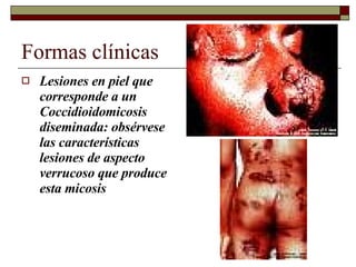 Formas clínicas Lesiones en piel que corresponde a un Coccidioidomicosis diseminada: obsérvese las características lesiones de aspecto verrucoso que produce esta micosis 