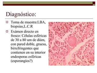 Diagnóstico: Toma de muestra:LBA, biopsias,L.C.R Exámen directo en fresco: Células esféricas de 30 a 80 um de diám, con pared doble, gruesa, birrefringentes que contienen en su interior endosporas esféricas (esporangios?) 